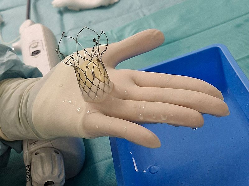 Deutschlandpremiere an den SHG-Kliniken Völklingen: Spezielles TAVI-System erstmals erfolgreich eingesetzt Die TAVI-Herzklappe unmittelbar vor der Implantation.